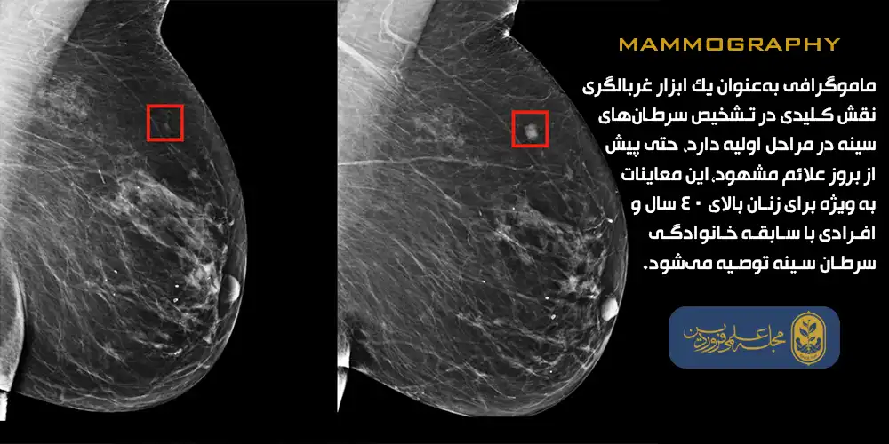 ماموگرافی_علائم سرطان سینه