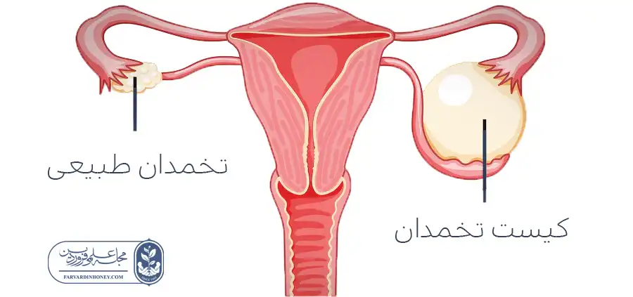 از کجا بدانیم کیست داریم-از کجا بفهمیم کیست داریم یا بارداریم- علائم کیست تحمدان