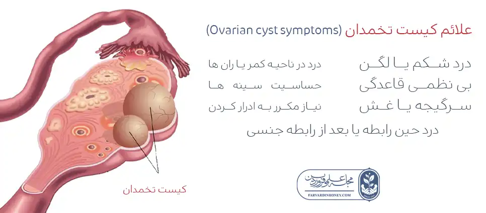 از کجا بفهمیم کیست تخمدان داریم-نشانه های کیست تخمدان