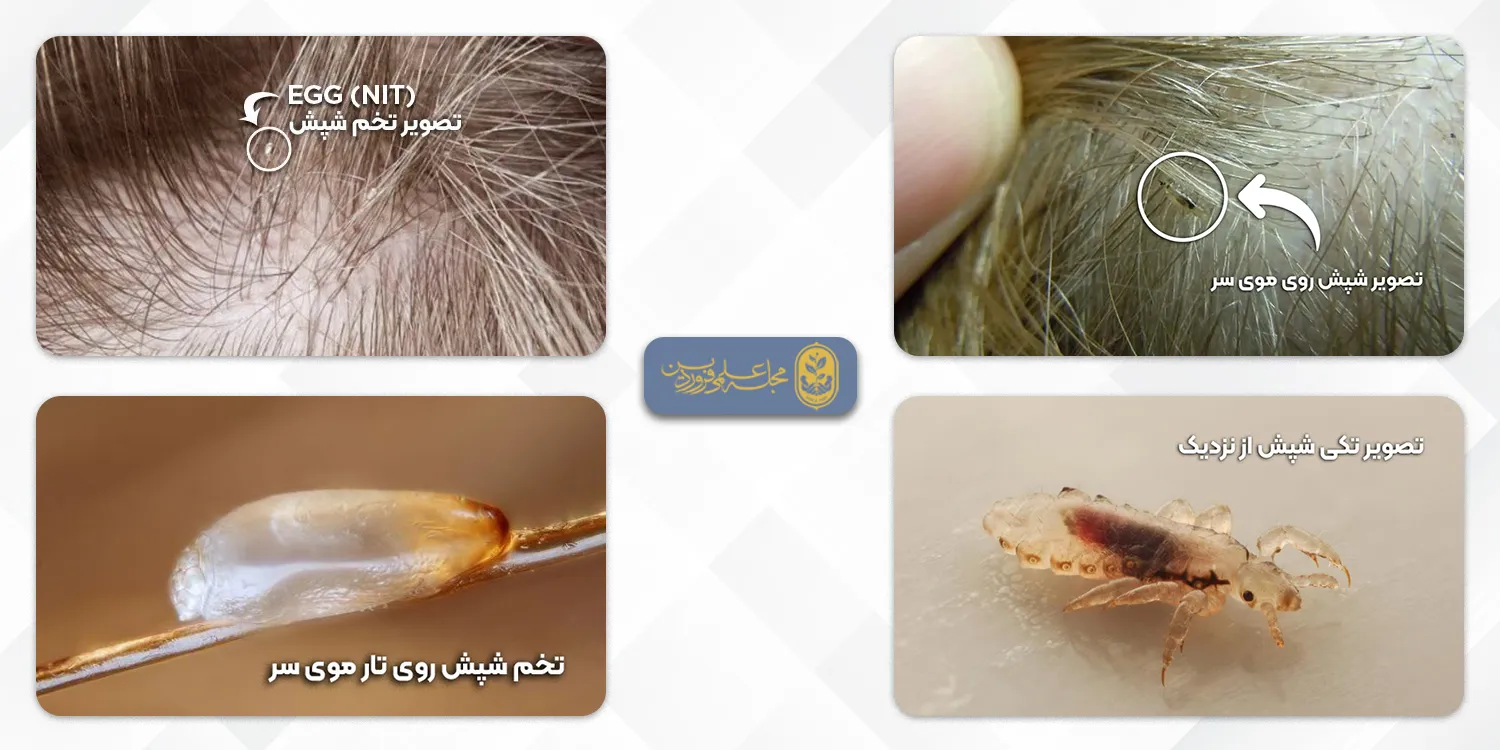 از بین بردن تخم شپش-عکس شپش از نزدیک-عکس تخم شپش-تخم شپش چه شکلیه-تخم شپش مرده-مجله علمی فروردین