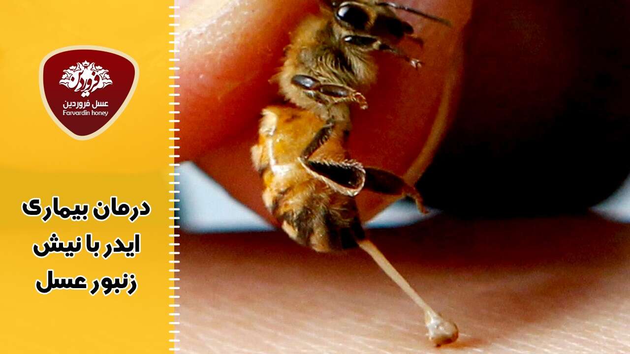 درمان بیماری ایدز (HIV) با نیش زنبور عسل