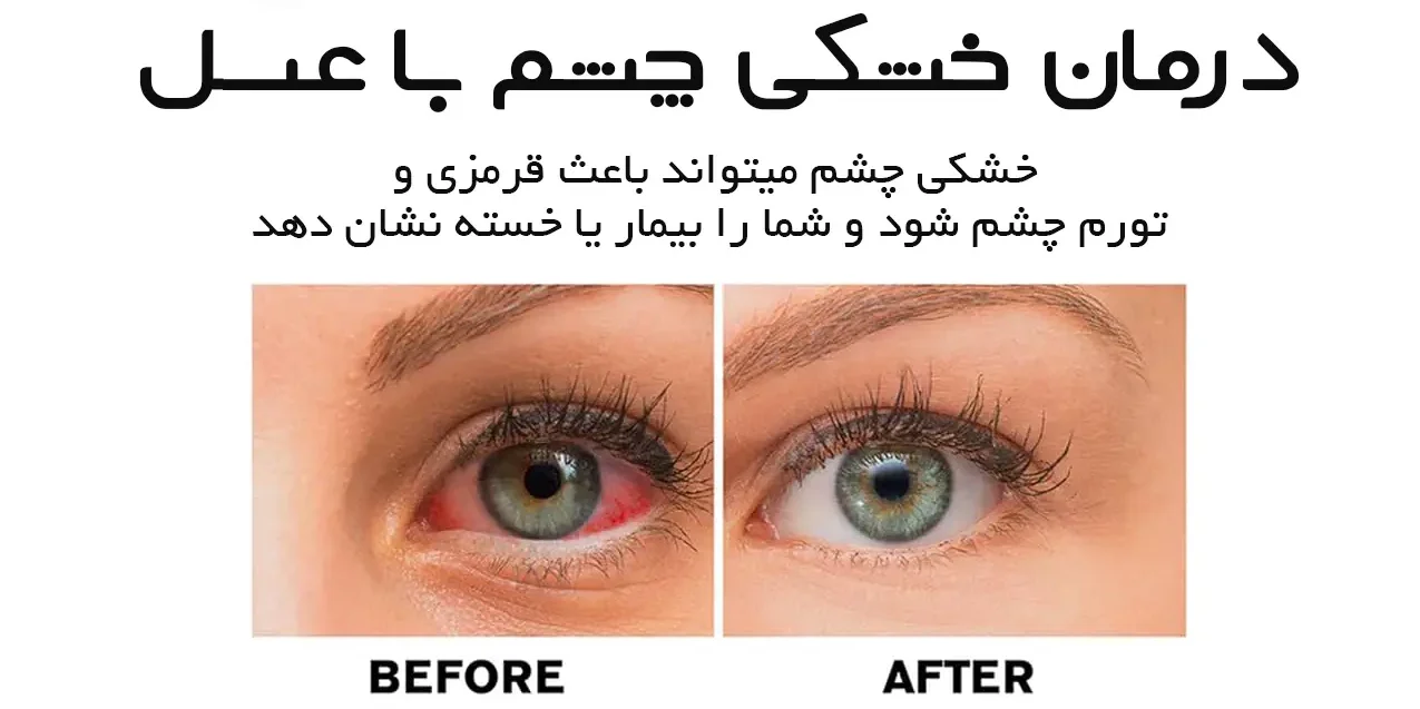 درمان خشکی چشم باعسل طبیعی فروردین