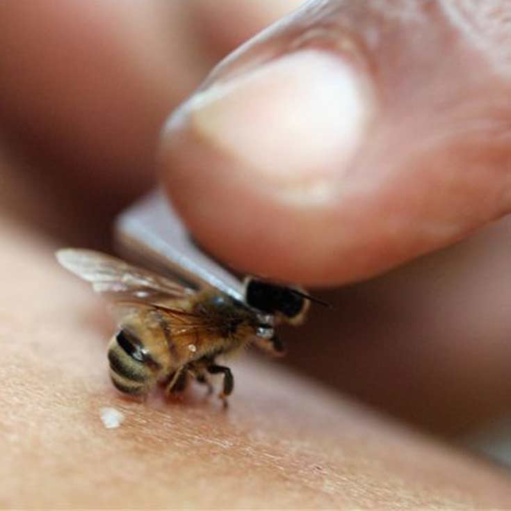 زنبور درمانی (نیش عسل)