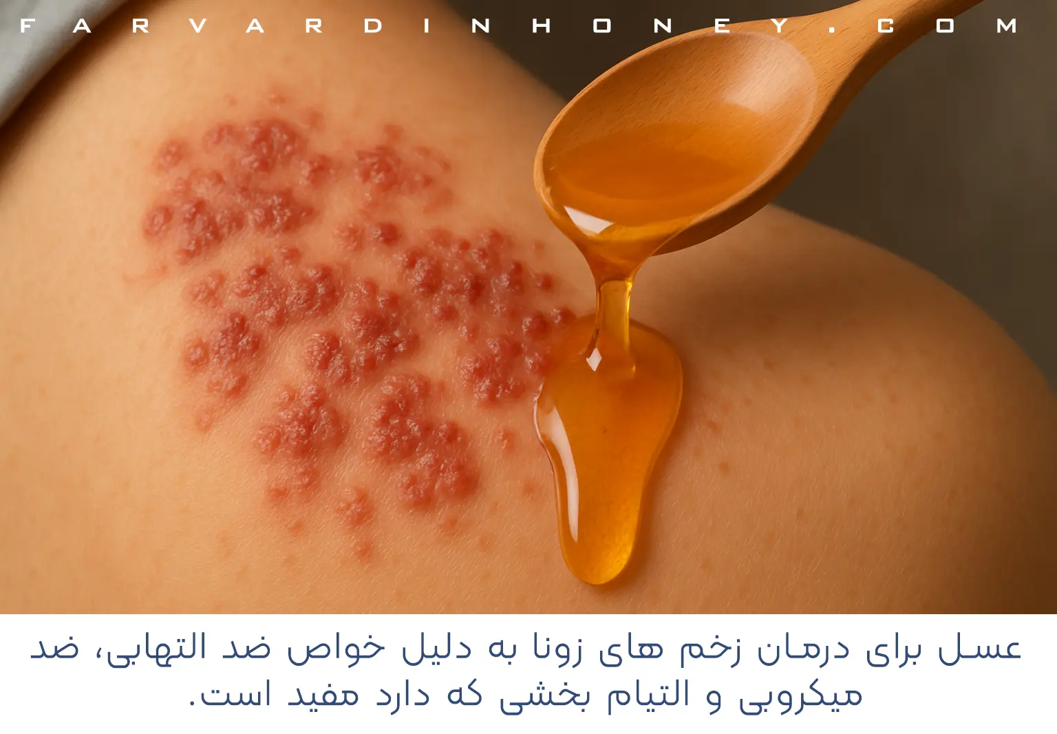 عسل برای زخم زونا- برای درمان زونا چه بخوریم
