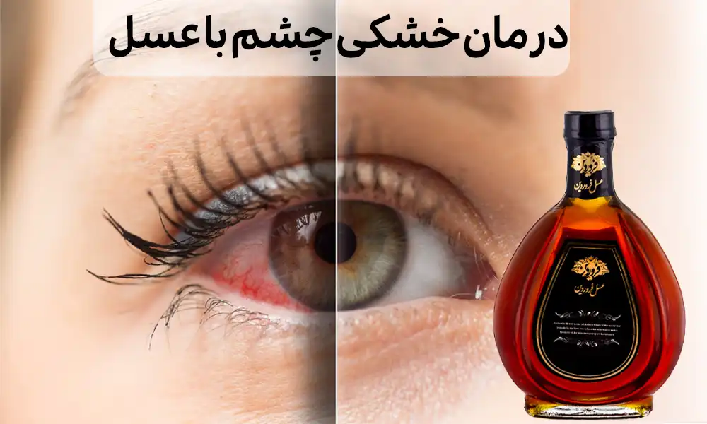 درمان خشکی چشم با عسل- درمان خانگی خشکی چشم-عسل برای خشکی چشم