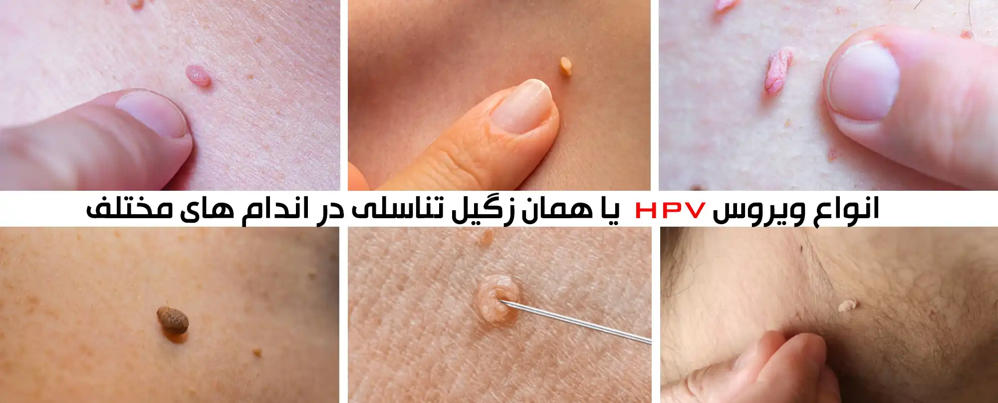 انواع زگیل تناسلی چیست_درمان زگیل تناسلی_ویروس hpv